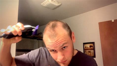 Receding Hairline Since 17 Shaving My Head Embracing Going Bald Live 2 Youtube