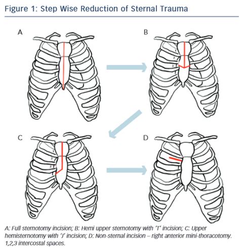 Know About Step Wise Reduction Of Sternal Trauma Radcliffe Cardiology