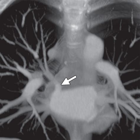 Learning From The Pulmonary Veins Radiographics