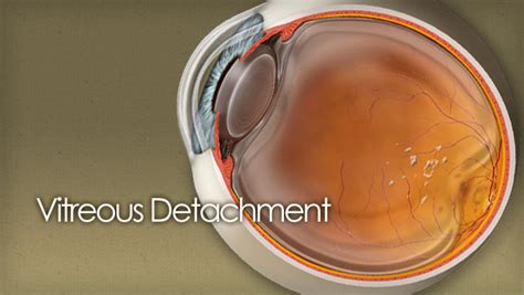 Vitreous Detachment Pvd Guide With Illustrations And Photos