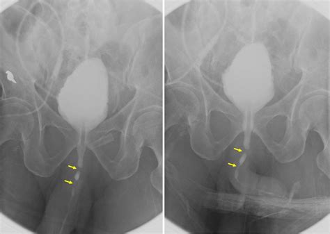 Anterior Urethral Strictures Radiology Cases