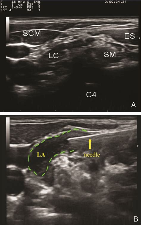 Ultrasound Guided Deep Or Intermediate Cervical Plexus Block