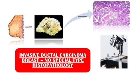 Invasive Ductal Carcinoma No Special Type Youtube