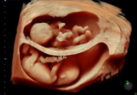 3d Ultrasounds At A Whole New Level Ultrasound Reveal Twins