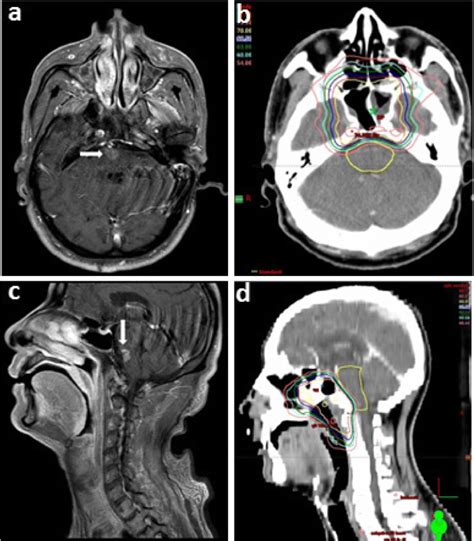 A Retrospective Dosimetry Study Of Intensity Modulated Radiotherapy For