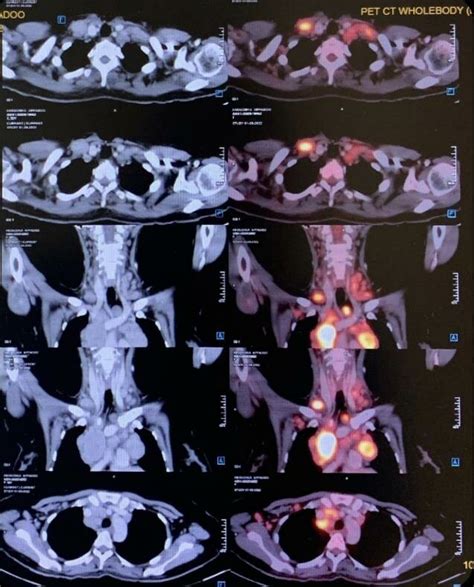 Diagnostic Pet Ct Showing Contiguous Generalised Lymphadenopathy Above