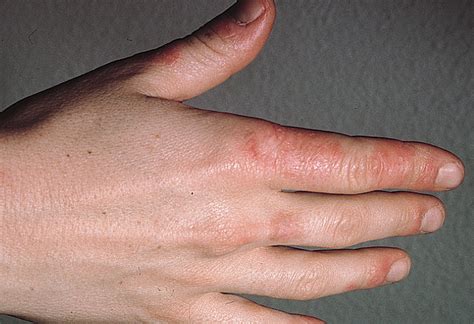 Discoid Lupus Erythematosuslike Lesions And Stomatitis Dermatology