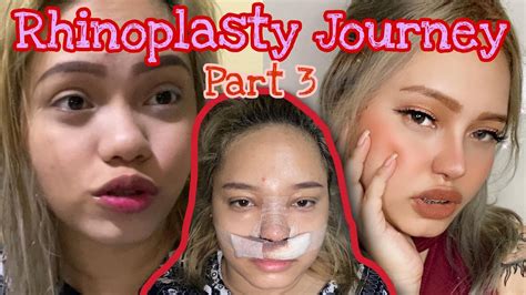 Rhinoplasty Philippines Vlog The Journey Tips Part 3 Youtube