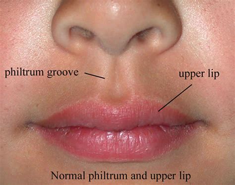 Philtrum Of Lip Causes Of Smooth Philtrum Long Or Short Philtrum