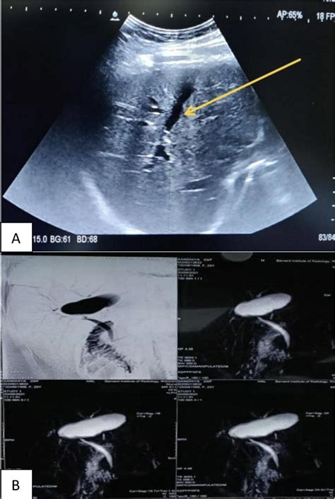 Figure 1 From A Rare Case Of Intrahepatic Gallbladder In The Setting Of