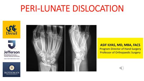 Lunate Dislocation