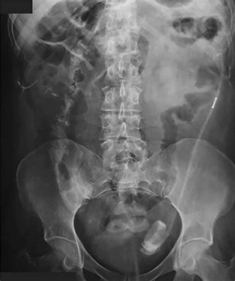Anteroposterior Abdominal Radiograph Showing The Migration Of The Band