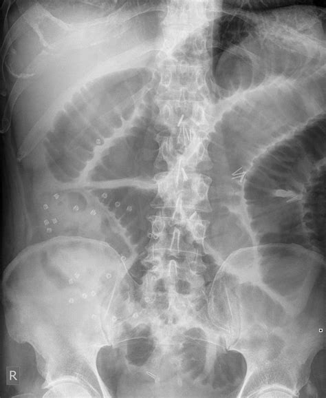 Small Bowel Obstruction Radiology Case Radiology