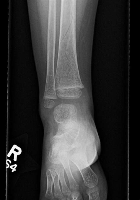 A Toddlers Tibia Common Yet Obscure — Brown Emergency Medicine