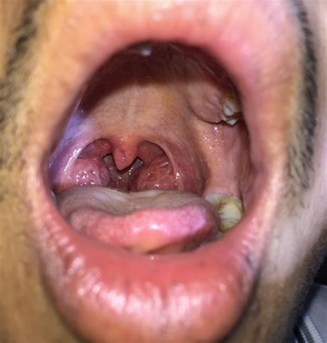 White Spots On Tonsils Causes Symptoms Treatment Pictures