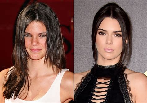 Kendall Jenner Before And After Plastic Surgery