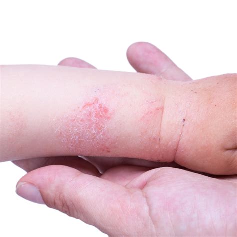 What Is Allergic Eczema Prozema