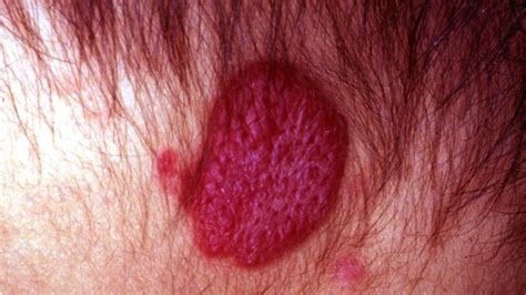 Raised Skin Bumps Pictures Causes And Treatment Images And Photos Finder
