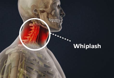 Whiplash Injury Causes Symptoms And Treatment Bonati