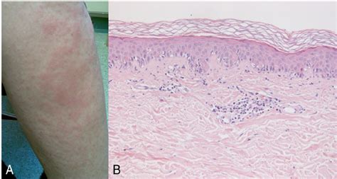 A Rash B Skin Biopsy Showing An Interface Dermatitis Reaction