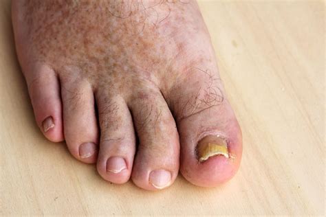 Toes Diseases Pictures Photos