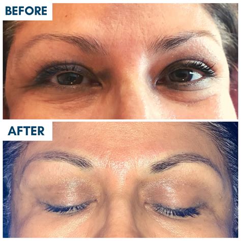 Microblading Prp Facial Treatment Feel Ideal 360 Med Spa