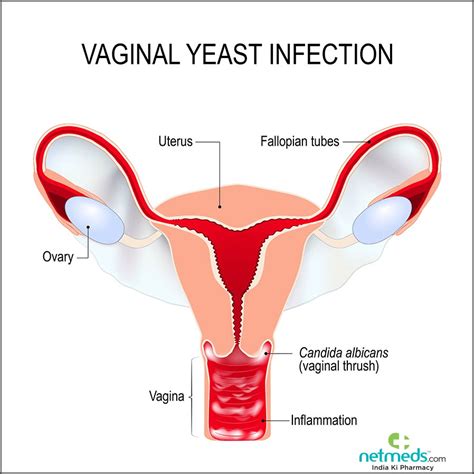 Vaginal Infections Pictures