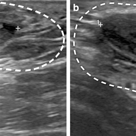 Sonographic Findings Of A Fibroadenoma In An Axillary Accessory Breast