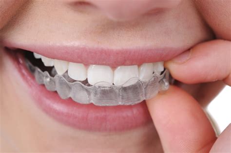 How Much Do Braces Cost In The Uk The Dental Guide