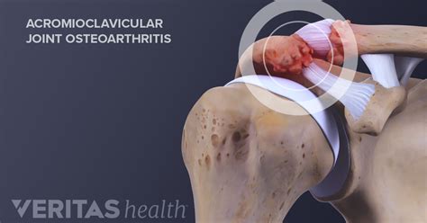 What Is Acromioclavicular Arthritis Ac Joint Arthritis Arthritis