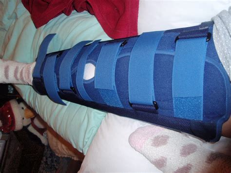 My Broken Knee Story Getting Around In A Splint