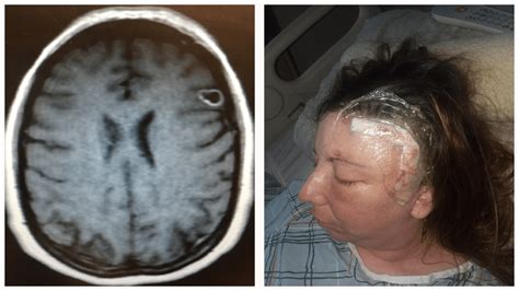 Womans Brain Tumor Turns Out To Be Parasite Growing In Her Head