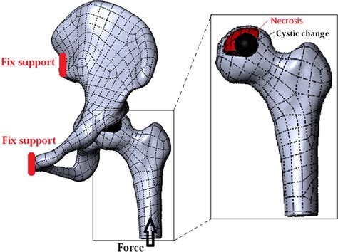 Effect Of Femoral Head Necrosis Cystic Area On Femoral Head Collapse