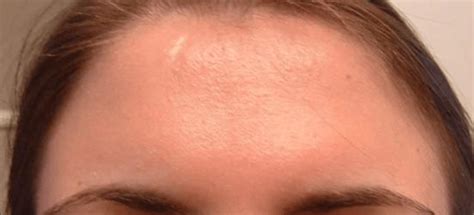Cyst On Foreheadcauses And Natural Remedies