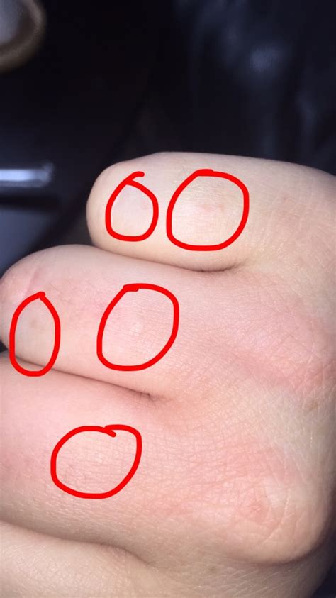 Why Do I Have Small Itchy Bumps On My Hands And Feet Printable