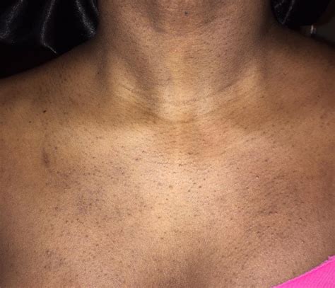 Ive Had These Tiny Dark Bumps On My Chest Not Sure What They Are Or