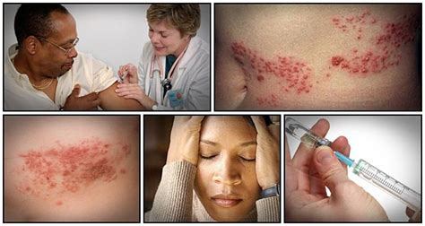 Fast Shingles Cure Teaches People How To Get Rid Of Their Herpes Zoster