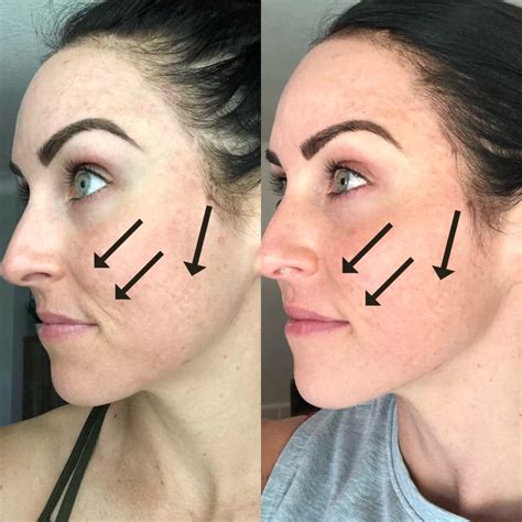 Gone Wrong Microneedling Before And After 1 Treatment