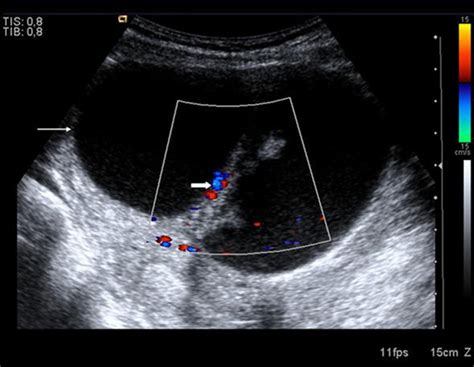 18 Year Old Female With Ovarian Torsion Color Doppler Ultrasound Image