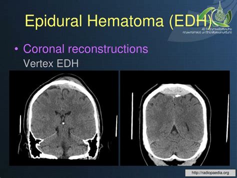 PPT - Basic Knowledge and Film Practices: Head Trauma ...