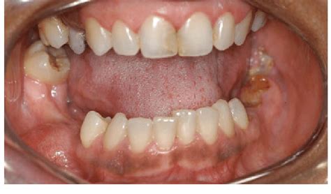 Intraoral View Showing A Swelling In The Right Posterior Mandible