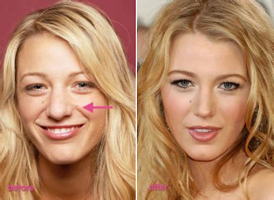 Blake Lively Nose Job Before And After Plastic Surgery Boob Jobs Star Plastic Surgery