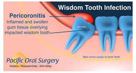 Can Wisdom Teeth Cause Ear Pain Boston Dentist Congress Dental