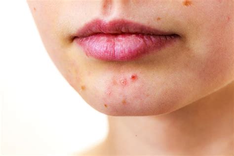 5 Surprising Causes Of Adult Acne And What You Can Do About It Orange Coast Dermatology