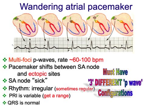 Wandering Atrial Pacemaker Rhythm Strip