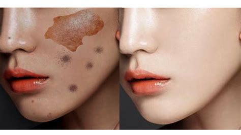 How To Get Rid Of Pigmentation Dark Spots And Uneven Skintone In Just 7