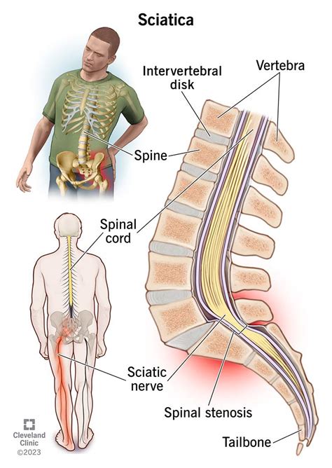 Sciatica What It Is Causes Symptoms Treatment And Pain Relief