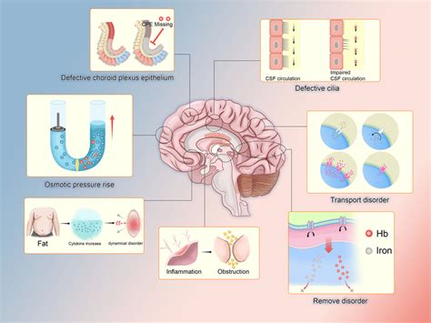 Hydrocephalus Related To Choroid Plexus Epithelium There Are Many