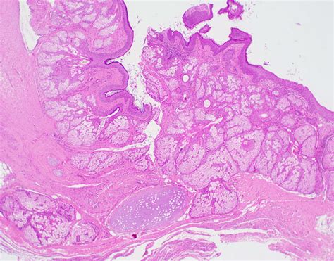 Dermoid Cyst Mature Cystic Teratoma Ovary BosnianPathology