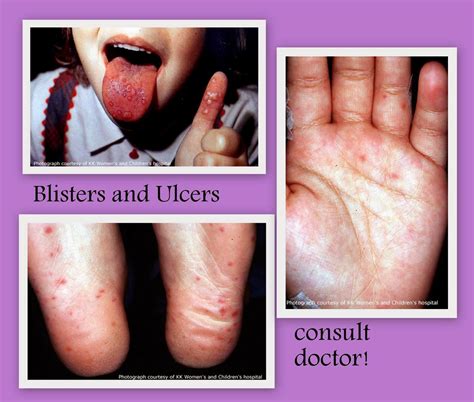 Rawatan Semulajadi Untuk Hfmd Hand Foot Mouth Disease ~ Butik Gebugebu